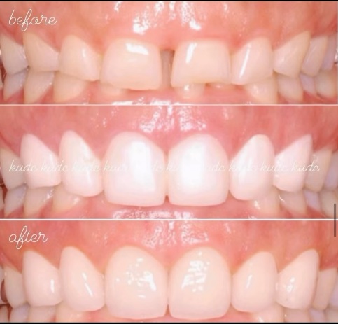 ガミースマイル改善 症例写真