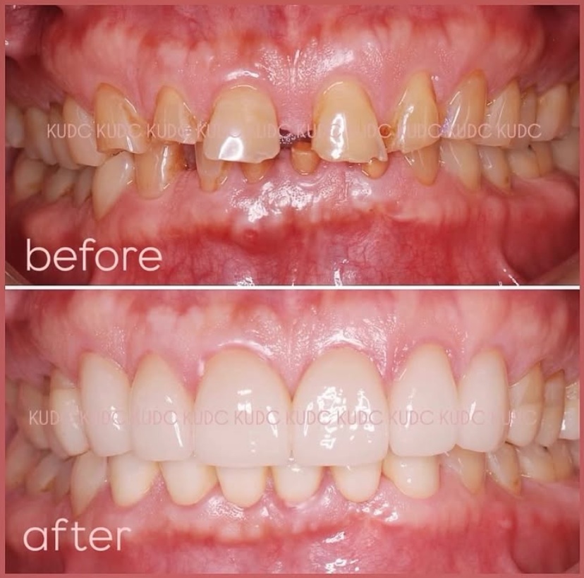 審美治療 症例写真