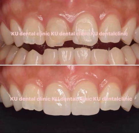 ラミネートベニア 症例写真