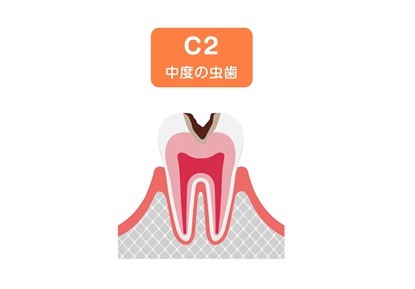 C2中等度虫歯