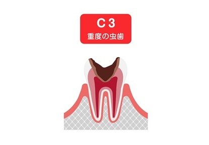 C3重度虫歯